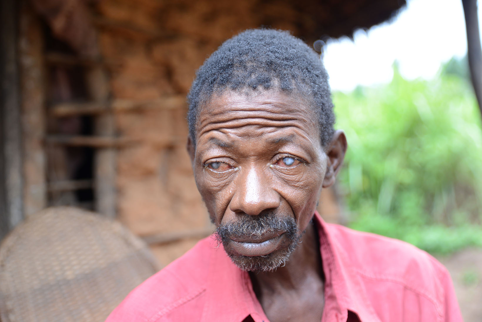 Ein älterer, von Flussblindheit betroffener Mann