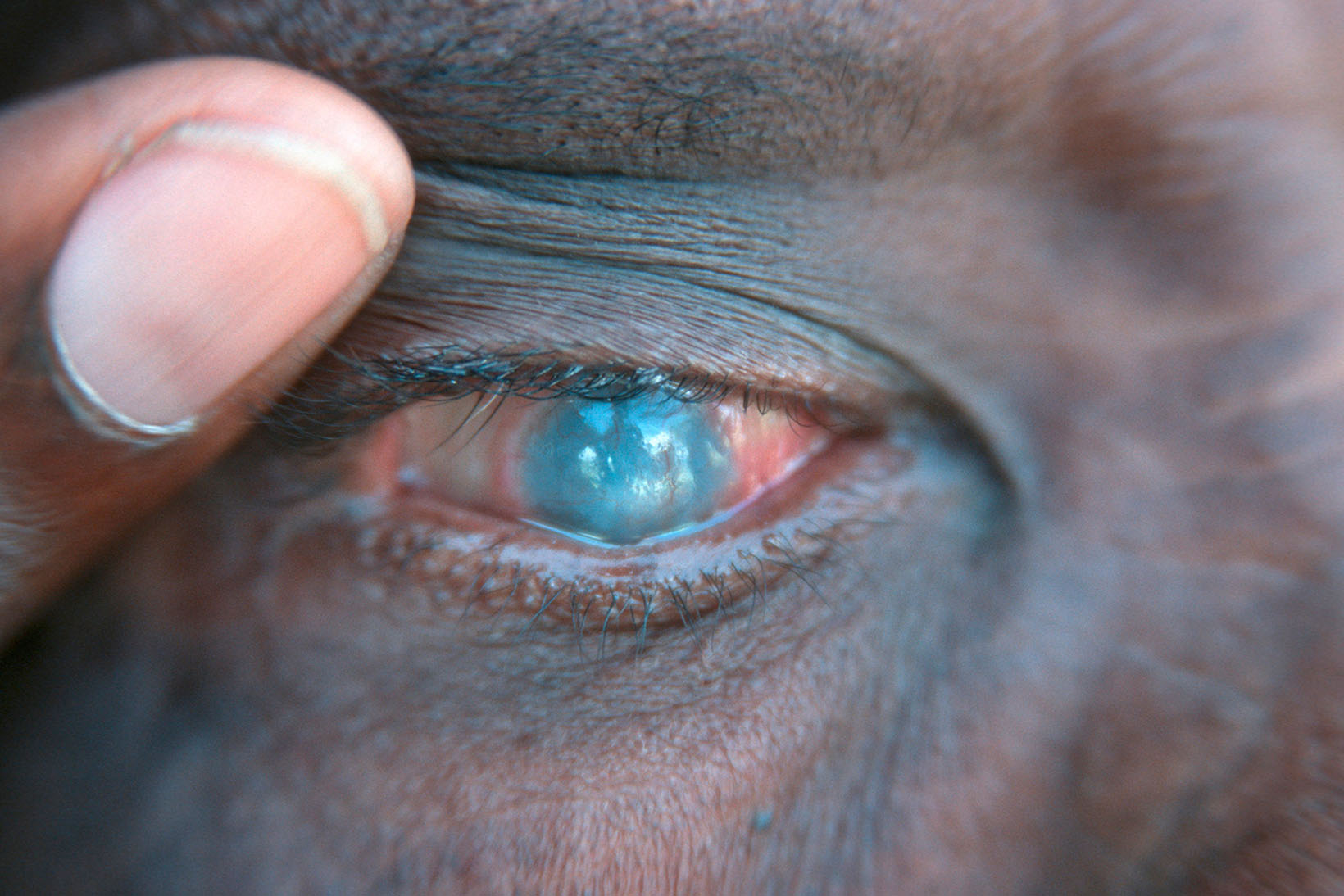 Un bambino colpito dal tracoma.