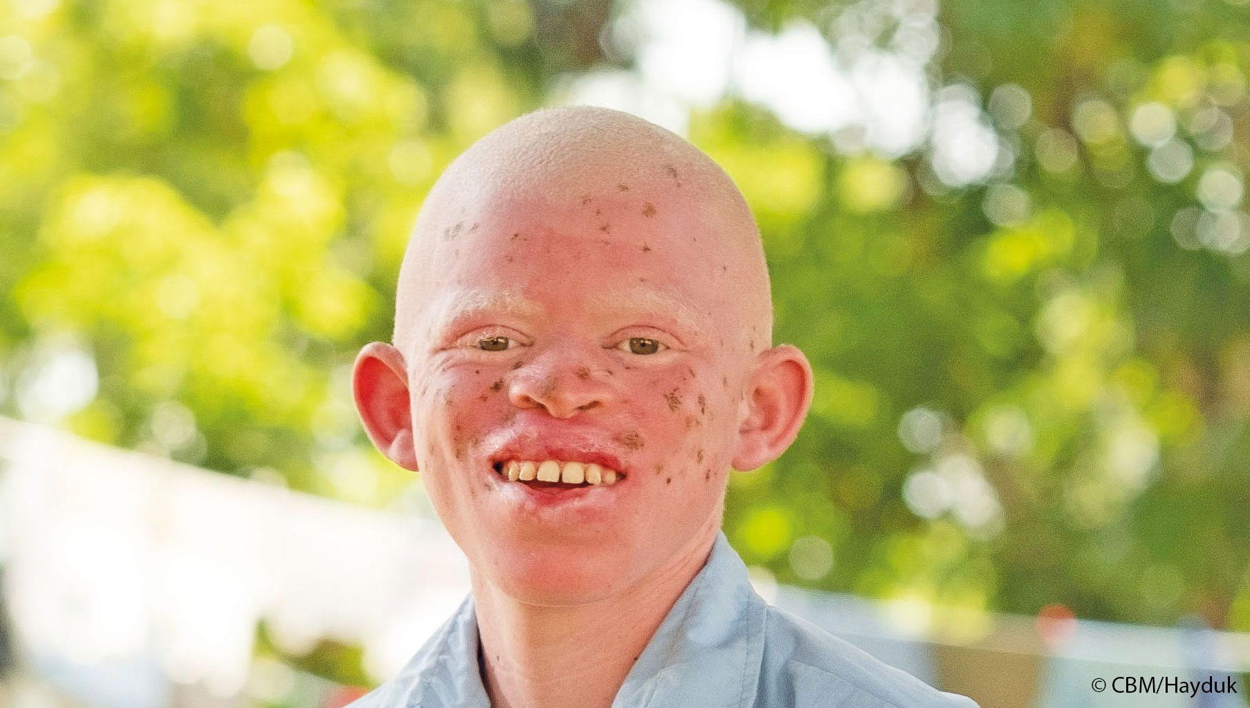 Link zur Geschichte von Elisha aus Kenia, der Albinismus hat.